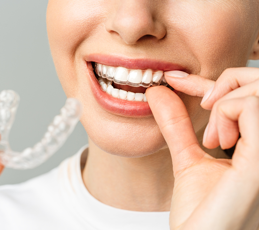 ortodoncia-tratamiento-dentales-aviles-02