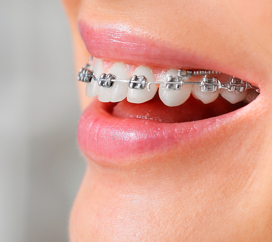 ortodoncia-tratamiento-dentales-aviles-03