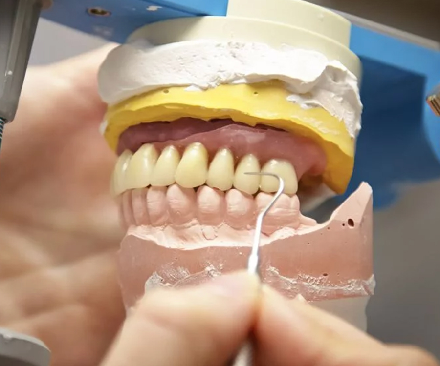 protesis-tratamiento-dentales-aviles-02